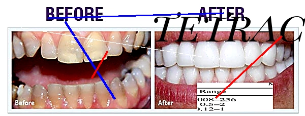 Tetracycline sans ordonnance